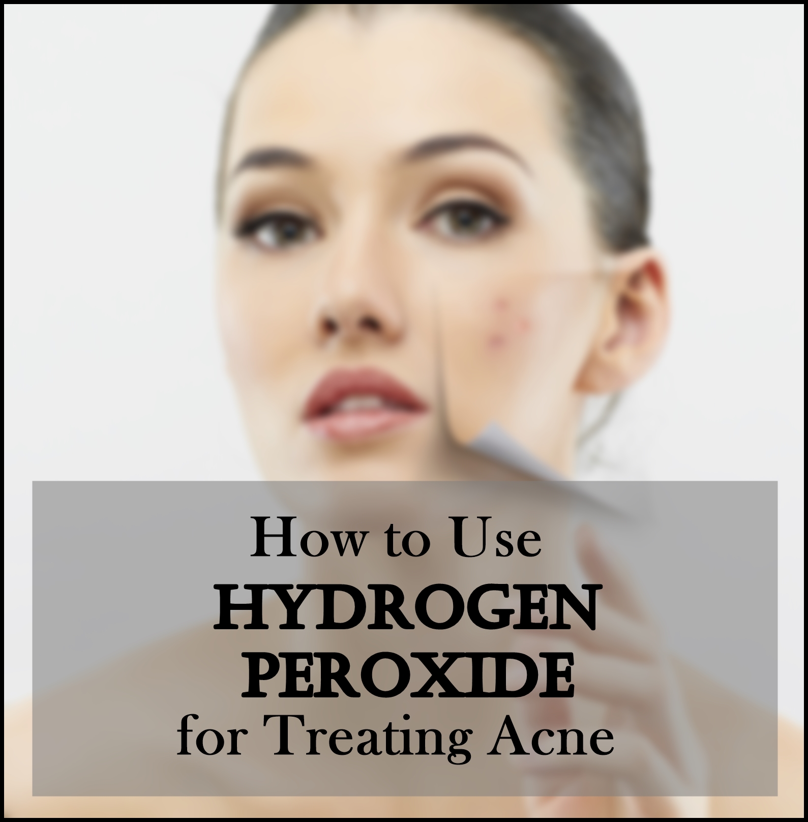 How To Use Hydrogen Peroxide For Treating Acne